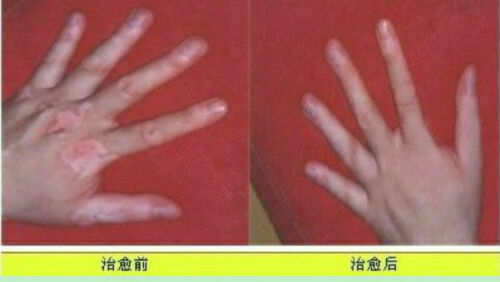 3 Packs BaiShiPills Skin Repigment TCM Therapy BAIYUNSHAN Vitiligo Treatment